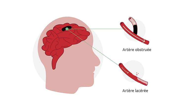 L'image montre les causes d'un accident vasculaire cérébral: un infarctus cérébral ou une hémorragie cérébrale.