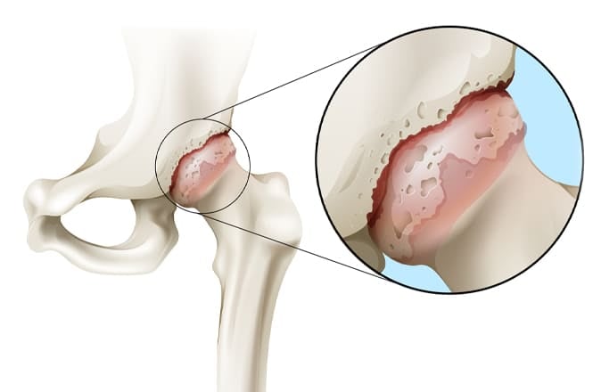 Presentation qu est ce que l arthrose de la hanche