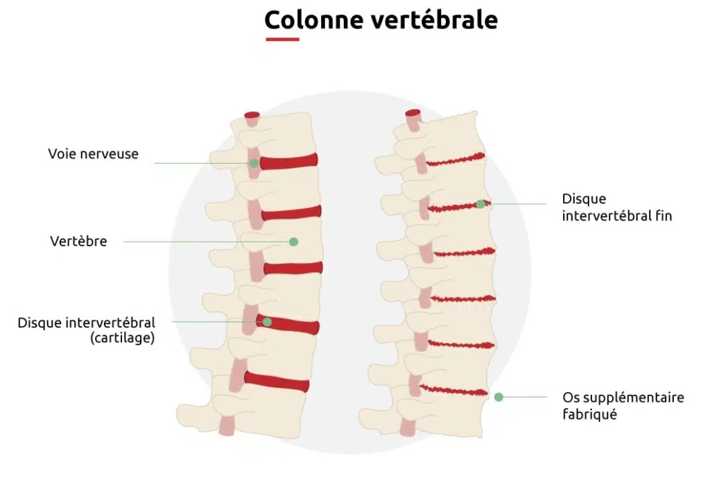 Une représentation schématique de ce qu'est l'arthrose du dos.