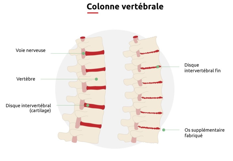 quels-sont-les-sympt-mes-de-l-arthrose-du-dos-otolift