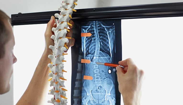 Un médecin montre une colonne vertébrale dans une position normale et une radiographie de la colonne vertébrale d'un adulte présentant des symptômes de scoliose