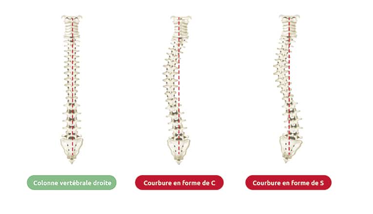 Une vertèbre dorsale normale et droite et des vertèbres en forme de C et de S affectées par la scoliose montrent clairement comment la scoliose peut provoquer différents symptômes physiques.