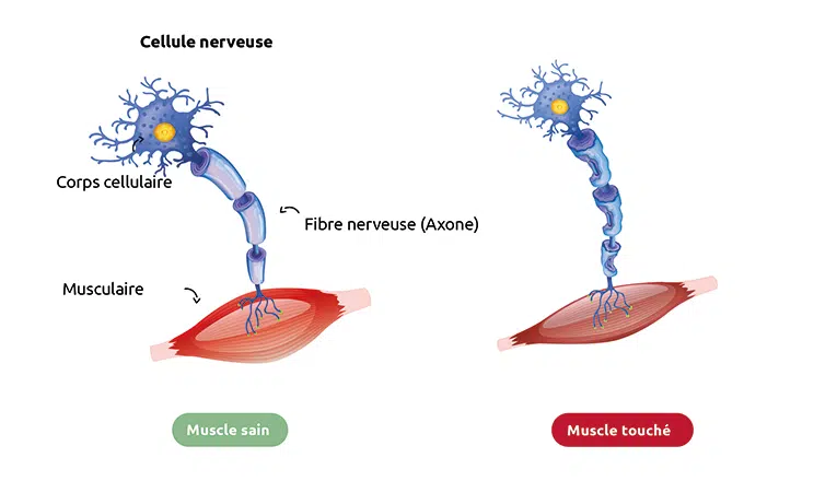 Représentation schématique d'un muscle atteint de SLA et d'un muscle sain.